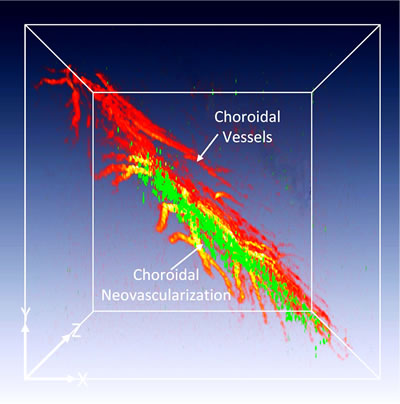 Gold Nanoparticle photoacoustic microscopy of choroidal neovascularization
